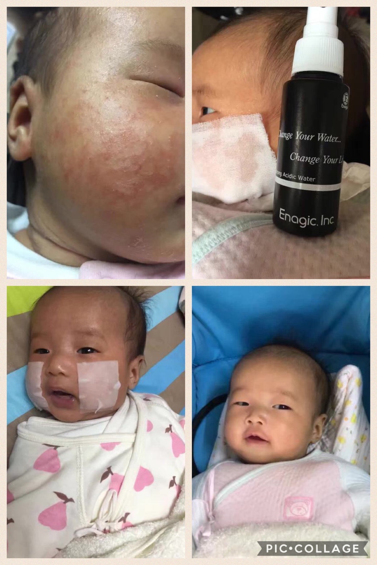 強酸水緩解小朋友凍瘡濕疹等問題