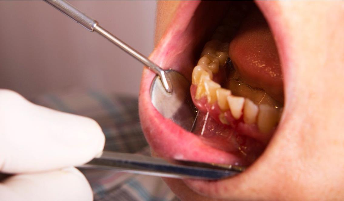 牙結石對口腔的影響